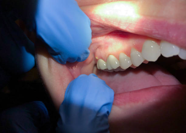 Best Emergency Dental Care for Sports Injuries in Grant City, MO