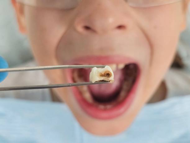 Best Knocked-Out Tooth (Avulsed Tooth) Treatment in Grant City, MO