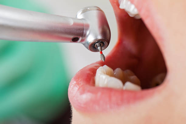 Best Emergency Wisdom Tooth Extraction in Grant City, MO